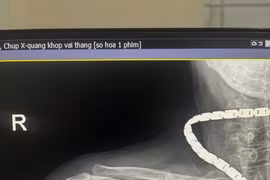 Đau vùng vai, hạn chế vận động sau ngã không ngờ gãy kín xương cánh tay