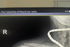 Đau vùng vai, hạn chế vận động sau ngã không ngờ gãy kín xương cánh tay