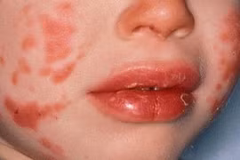 Trẻ sốt, viêm kết mạc cẩn thận bệnh Kawasaki gây bệnh tim nguy kịch