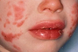 Trẻ sốt, viêm kết mạc cẩn thận bệnh Kawasaki gây bệnh tim nguy kịch