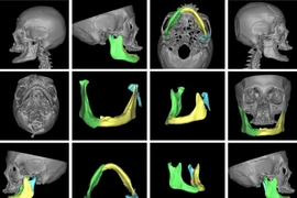 Phẫu thuật kép điều trị bệnh nhân 77 tuổi gãy xương hàm trên nền u não