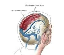 Ai có nguy cơ mắc huyết khối tĩnh mạch não?