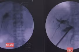 Tán sỏi túi mật xuyên gan qua da
