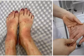 Nhiều người mắc bệnh da biến chứng nặng trong thời tiết giao mùa