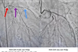 Bệnh nhân hai lần ngừng tim được cứu sống nhờ can thiệp kịp thời