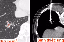 Cảnh báo, nhiều người chụp CT phổi kiểm tra sức khỏe phát hiện ung thư