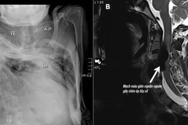 Hiếm gặp: Rò động tĩnh mạch cột sống liệt tứ chi trên nền gù vẹo nặng