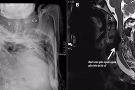 Hiếm gặp: Rò động tĩnh mạch cột sống liệt tứ chi trên nền gù vẹo nặng