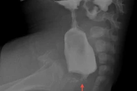 Nội soi điều trị bệnh không hậu môn cho trẻ sơ sinh tại Hải Phòng