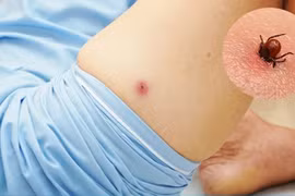 Tổn thương gan, phổi chỉ từ nốt loét nhỏ do mò đốt