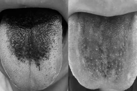 Lưỡi đen bất thường có phải bệnh nguy hiểm?