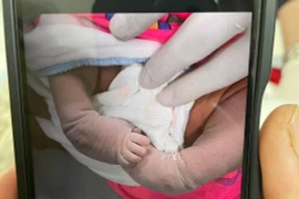 Chữa chân khoèo cho trẻ ngay từ những ngày đầu đời