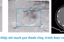 Đau chướng bụng do u gan chảy máu tràn dịch màng bụng
