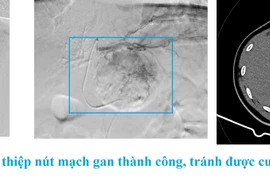 Đau chướng bụng do u gan chảy máu tràn dịch màng bụng