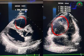 Đau tức ngực, suy hô hấp vì thuốc tránh thai gây thuyên tắc phổi