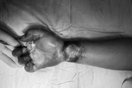 Bỏng điện nguy kịch khi dựng cây nêu đón Tết, cách gì phòng tránh?