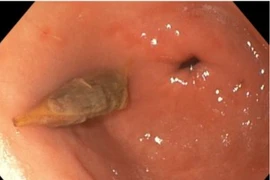 Gắp thành công dị vật hạt táo đỏ đâm vào thành dạ dày người bệnh