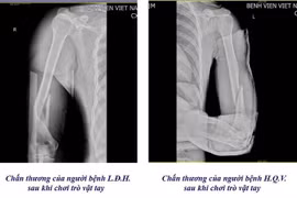 1 tuần 3 trường hợp gãy xương cánh tay từ trò chơi vật tay