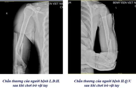 1 tuần 3 trường hợp gãy xương cánh tay từ trò chơi vật tay