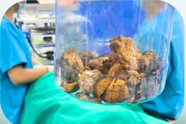 Lấy bã thức ăn 'khổng lồ' 15cm trong dạ dày cụ bà 85 tuổi thích ăn hồng ngâm