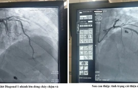 Hồi sinh sự sống cho người bệnh đau ngực cấp do nhồi máu cơ tim