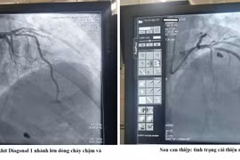 Hồi sinh sự sống cho người bệnh đau ngực cấp do nhồi máu cơ tim