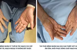 Hút nhiều cục máu đông giúp bệnh nhân 97 tuổi tránh nguy cơ hoại tử