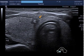 Không có triệu chứng, phát hiện ung thư tuyến giáp 2 bên kèm hạch cổ