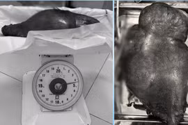 Cắt khối u nặng 4,5 kg cho người phụ nữ đợi suốt 10 năm chờ u biết mất