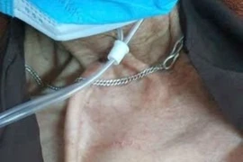 Cảnh báo nguy hiểm chết người khi tự cắt catheter đường hầm lọc máu