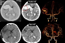 Cứu sống bệnh nhi hôn mê do vỡ dị dạng mạch máu não bị bệnh cơ tim hiếm gặp