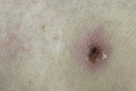 Căn bệnh nguy hiểm gây nhiễm khuẩn huyết từ vết cắn nhỏ của mò