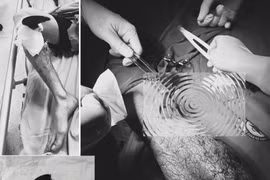 Hướng dẫn xử lý tai nạn lao động đúng cách để bảo vệ chi thể