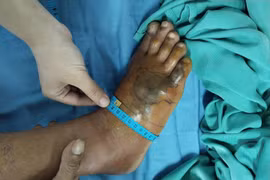 Người đàn ông Ninh Bình hoại tử chân vì bị rắn lục cắn