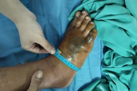 Người đàn ông Ninh Bình hoại tử chân vì bị rắn lục cắn