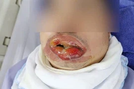 Người đàn ông bị bỏng nặng vùng miệng do xịt khí lạnh chữa bỏng