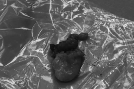 Phẫu thuật u tuyến giáp thành công cho bệnh nhân cao tuổi kèm bệnh nền