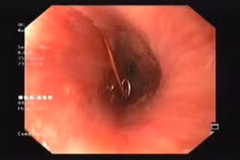 Cây kim băng dài nhọn kẹt trong lòng thực quản bé 12 tháng