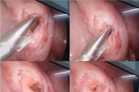 Trẻ 6 tuổi ngã xe đạp điện đau bụng, không ngờ vỡ ruột