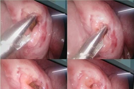 Trẻ 6 tuổi ngã xe đạp điện đau bụng, không ngờ vỡ ruột