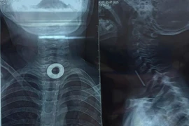 Chơi đùa, trẻ 7 tuổi nuốt phải kim loại 2cm kẹt trong thực quản