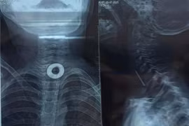 Chơi đùa, trẻ 7 tuổi nuốt phải kim loại 2cm kẹt trong thực quản