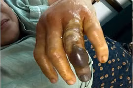 Bàn tay của bệnh nhân