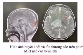 Bé trai hôn mê do huyết khối tĩnh mạch nội sọ