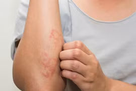 Nhận biết đúng bệnh viêm mao mạch dị ứng phổ biến ở trẻ