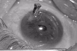 Đinh bắn xuyên mắt người đàn ông 27 tuổi nguy cơ mất thị lực vĩnh viễn