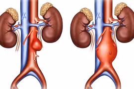 Động mạch chủ bụng phình to gấp ba bình thường sau cơn đau bụng