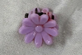 Xử trí dị vật bất thường đường âm đạo cho bé gái 8 tuổi 