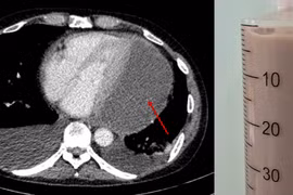 Đau ngực người đàn ông bị tràn mủ màng ngoài tim hiếm gặp