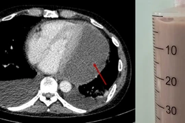 Đau ngực người đàn ông bị tràn mủ màng ngoài tim hiếm gặp